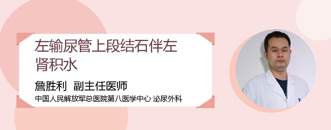 左输尿管上段结石伴左肾积水